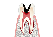 C3：神経の虫歯